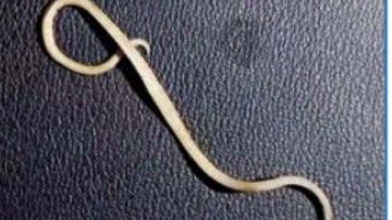 أعراض وطرق الوقاية وعلاج ديدان الإسكارس .. الصحة توضح أعراض وطرق الوقاية وعلاج ديدان الإسكارس .. الصحة توضح