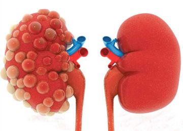 تظهر على القدمين.. احذر من علامات الفشل الكلوي تظهر على القدمين.. احذر من علامات الفشل الكلوي