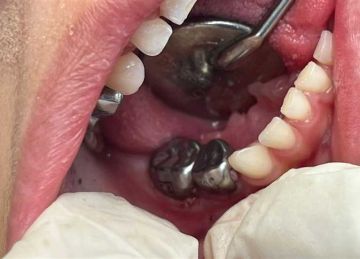 الفوائد والخطوات.. تعرف على كل ما يخص زراعة الأسنان