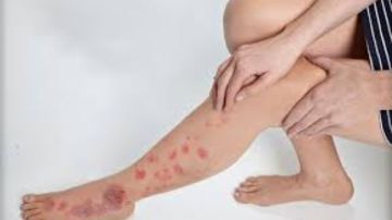 مرض نادر ينتشر بسرعة.. إذا ظهرت عليك هذه الأعراض راجع الطبيب فورا