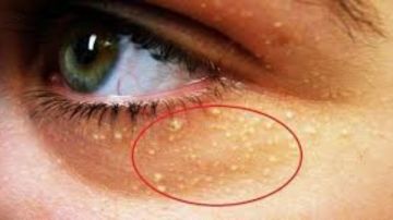 علامات خفية في الوجه تنذر بارتفاع الكوليسترول دون أن تشعر