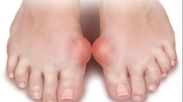 كل ما لا تعرفه عن النقرس.. علامة واحدة في قدمك قد تكشف إصابتك بالمرض