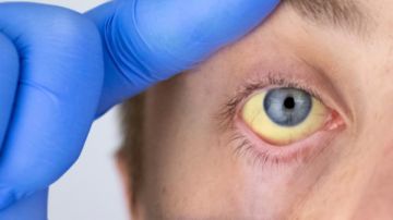 إلتهاب الكبد الوبائي.. الأعراض وأسباب العدوى والوقاية منه