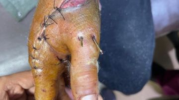 استغرقت 6 ساعات.. إنقاذ شاب تعرض لبتر كامل بإصبع الإبهام بمستشفى سوهاج الجامعي