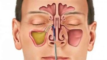 التهابات الجيوب الأنفية مابين أعراض وأسباب