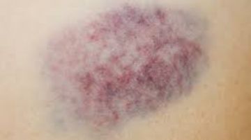 هل ظهور الكدمات المفاجئة ناقوس خطر يجب معالجته؟