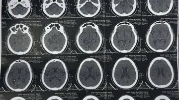 الدقهلية ..نجاح وحدة إذابة الجلطات بمستشفى السنبلاوين في إنقاذ حالتين سكتة دماغية