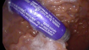 استخراج بطارية من معدة طفل 3 سنوات في 5 دقائق بمجمع الشفاء الطبي ببورسعيد