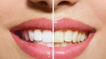 طرق طبيعية لتبييض الأسنان
