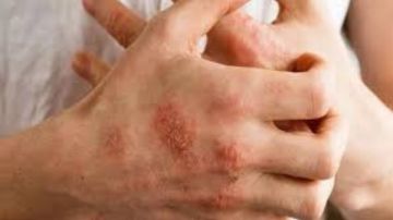 جوزة الطيب وجل الصبار.. 10 وصفات طبيعية لعلاج الإيكزيما