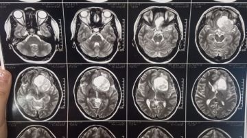بالميكروسكوب الجراحي.. استئصال ورم ضخم بقاع الجمجمة بمستشفيات سوهاج الجامعية ما القصة؟