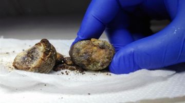 حسام موافي يحذر من مشاكل المرارة في سن صغيرة .. فيديو حسام موافي يحذر من مشاكل المرارة في سن صغيرة .. فيديو