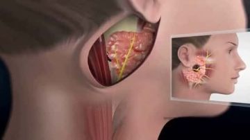 تشبه الانفلونزا .. اكتشف أعراض غدة النكاف