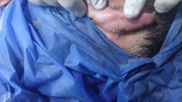 بعد قطع أذنه..مستشفى بلبيس بالشرقية تنجح في إعادة زرع وترميم أذن شاب تعرض لحادث سير بعد قطع أذنه..مستشفى بلبيس بالشرقية تنجح في إعادة زرع وترميم أذن شاب تعرض لحادث سير