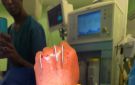 بعد 6 ساعات .. فريق جراحة التجميل بمستشفيات جامعة أسوان ينجح في إعادة يد مبتورة 