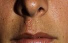 طرق علاج قرحة البرد تحت الأنف.. كيف تتخلصين منها وتمنعين انتشارها؟