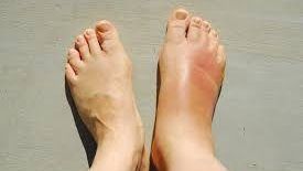 عشبة غير متوقعة تعالج احتباس السوائل والضغط