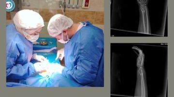 جراحة دقيقة تنهي معاناة طفلة من ذوي الهمم وتعيد لها الحركة بالمنوفية