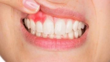 علاج التهاب اللثة.. إليك أفضل الطرق