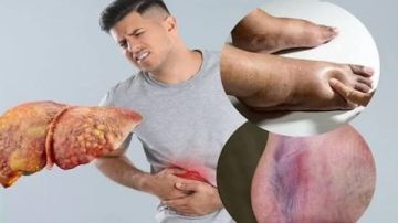 علامات وأعراض الكبد الدهني .. مرض صامت قد يتطور دون إنذار مبكر