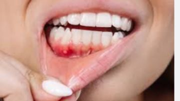 علامة تحذير مبكرة لـ سرطان الفم والحلق.. ما هي؟