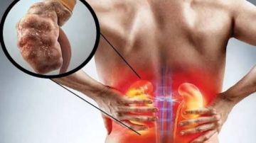 اعرف تطور أمراض الكلى المزمنة وأهم مراحلها.. ونصائح للسيطرة اعرف تطور أمراض الكلى المزمنة وأهم مراحلها.. ونصائح للسيطرة