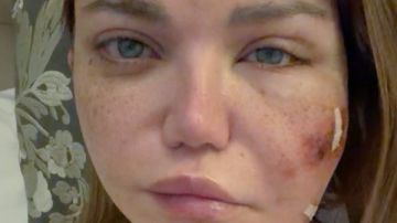 جراحة دقيقة .. ياسمين الخطيب تعلن إصابتها بعدوى بكتيرية في أنسجة بشرة الوجه