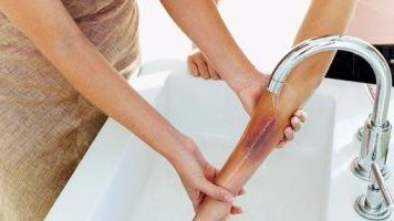 هبة السويدي : عند التعرض لحرق يجب وضعه تحت ماء فاترة 20 دقيقة ثم التوجه للمستشفى