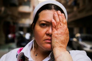  التبرع بالجلد يعيد جدل زراعة الأعضاء في مصر