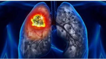 170 ألف مصاب بالسرطان سنويا في مصر.. نواب: لا بد من وضع سياسة لتشجيع الأبحاث في مجال الأورام.. ومطالب بالإسراع في التحول الرقمي لإصدار قرارات العلاج وتقليل زمن الإجراءات