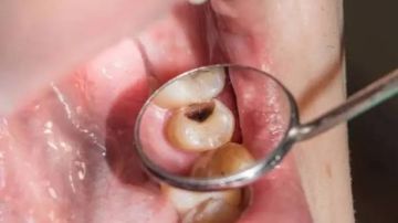 أسباب تسوس الاسنان وكيف يمكن الوقاية منه باتباع عادات صحية بسيطة؟