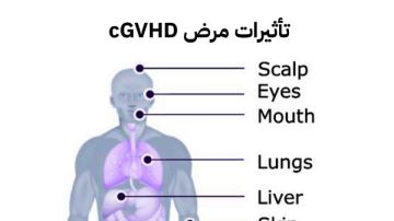 ما بعد زراعة النخاع العظمي؟ في ضوء اليوم العالمي لمرضى الطرد العكسي ضد النخاع ما بعد زراعة النخاع العظمي؟ في ضوء اليوم العالمي لمرضى الطرد العكسي ضد النخاع