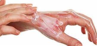 لا يسبب تشوهات الصحة : مصر الأكثر إصابة بالحروق .. والتبرع بالجلد يكون بالطبقة السطحية