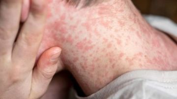 وفاة 15 طفلا في إسرائيل بسبب مرض شديد العدوى