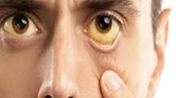 الكبد الدهني وتأثيره على العين.. كيف تحمي نفسك؟