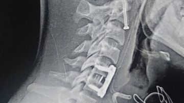 جراحة دقيقة بمستشفى بنها الجامعى تنقذ مريضا من الشلل جراحة دقيقة بمستشفى بنها الجامعى تنقذ مريضا من الشلل