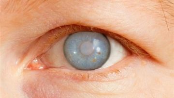 الجلوكوما .. مرض العين الصامت قد يسرق البصر دون إنذار
