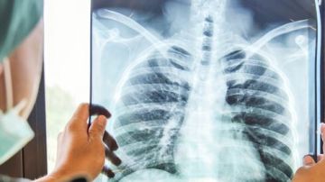 بعد تحذير الولايات المتحدة من انتشاره.. ما أعراض السل بعد تحذير الولايات المتحدة من انتشاره.. ما أعراض السل