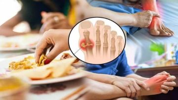 3 علامات هامة تكشف عن زيادة حمض اليوريك في الجسم