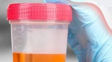 من الأصفر الباهت إلى الأحمر.. ألوان البول تشير إلى مشكلات في الكلى من الأصفر الباهت إلى الأحمر.. ألوان البول تشير إلى مشكلات في الكلى