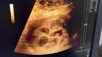 بعد تأخر الإنجاب 4 سنوات.. سيدة مصرية تحمل في 8 توائم طبيعيا