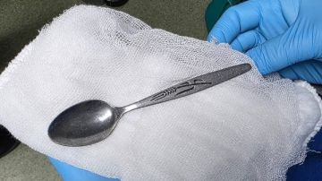 في ليلة العيد.. استخراج ملعقة من معدة فتاة في المنوفية في ليلة العيد.. استخراج ملعقة من معدة فتاة في المنوفية