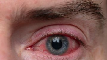 ليس مجرد حساسية 10 أسباب مرضية قد تفسر احمرار العين