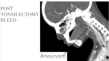 فريق طبي بمستشفيات سوهاج الجامعية ينقذ حياة طفلة بغلق تمدد شرياني دون جراحة