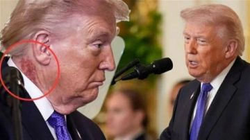 سر البقعة الحمراء على رقبة ترامب.. هل عقاب إلهي على الحرب الإيرانية؟!