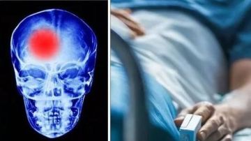 احترس.. هذه العوامل تسبب جلطة الدماغ