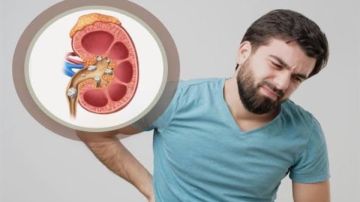 احذروها.. مشروبات شهيرة تسبب حصوات الكلى