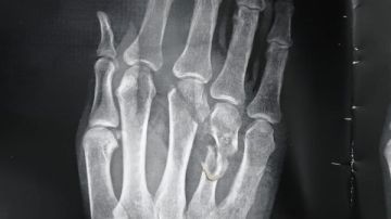 تدخل جراحي دقيق بمستشفى قنا العام ينقذ يد شاب من البتر تدخل جراحي دقيق بمستشفى قنا العام ينقذ يد شاب من البتر