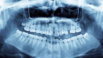 ابتسامة قياسية.. رجل يكتشف بعد 42 عاما أنه يملك أكبر عدد من الأسنان في العالم