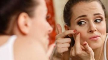 طرق طبيعية لعلاج حب الشباب.. حلول آمنة لبشرة صافية